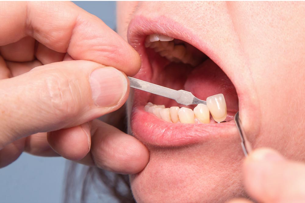 Dentist checking and selecting color of teeth